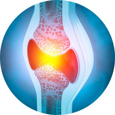 Gelenksanierungsprozess mit Icexin-Gel.