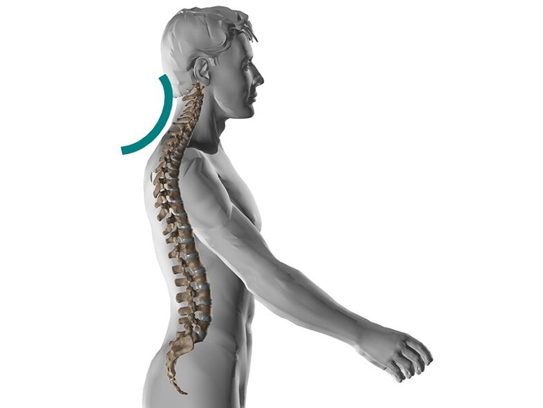 Zervikale Osteochondrose der Wirbelsäule, die viele unangenehme Symptome verursacht.