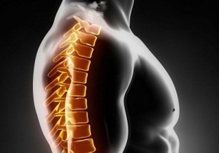 Die thorakale Osteochondrose geht mit Schmerzen und Beschwerden im mittleren Rücken einher.