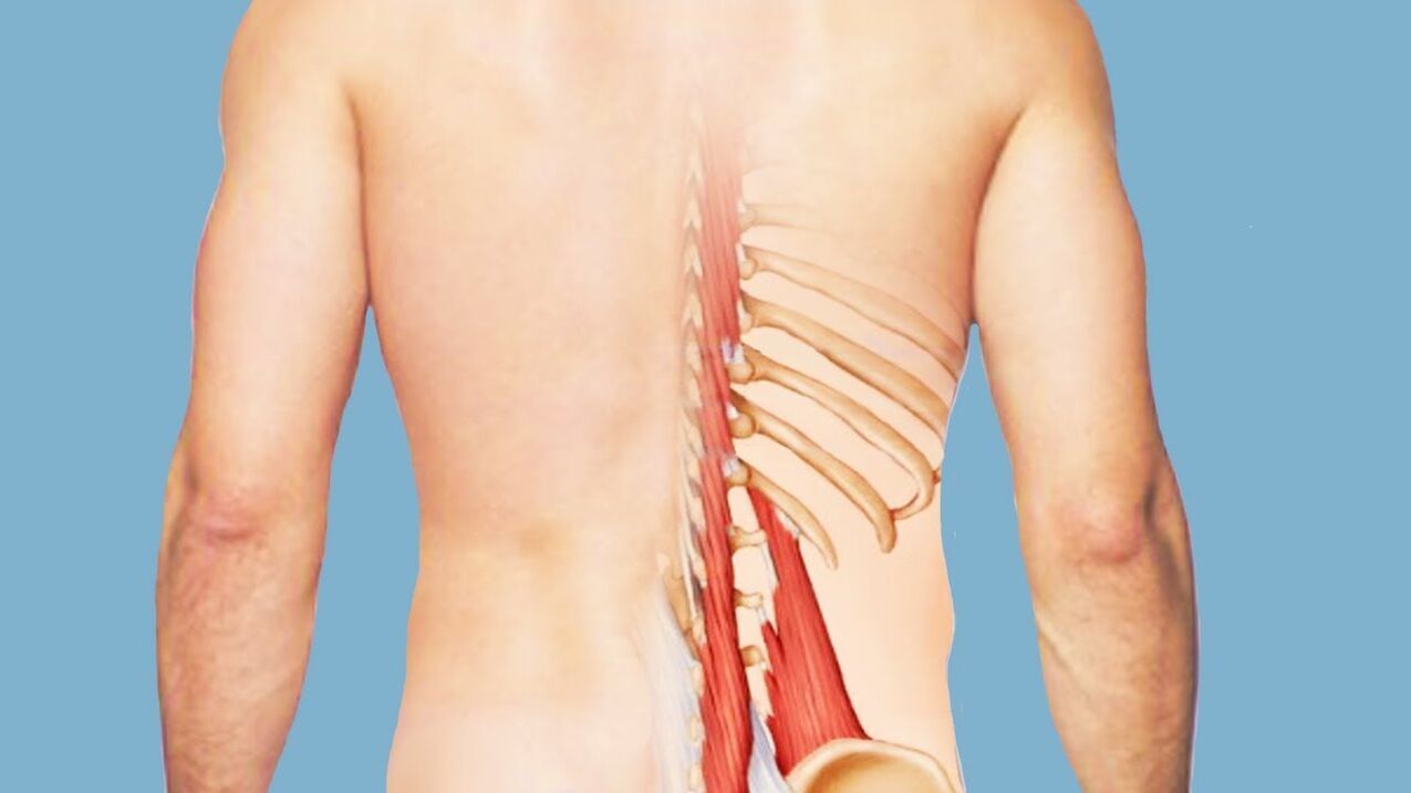 Myositis als Ursache für Rückenschmerzen.